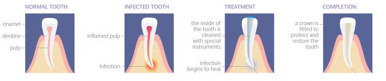 Endodontic Treatment