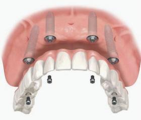Smile in a Day Upper Jaw Implant Placement
