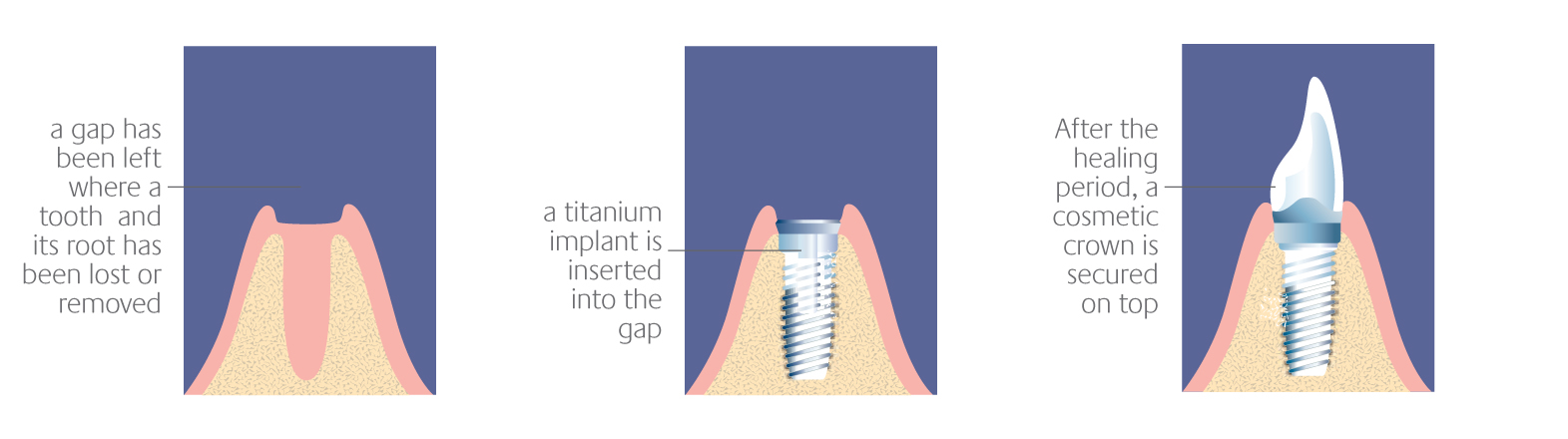 Implant Placement